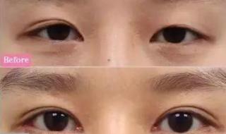 眼皮下垂解决方法 眼皮下垂解决方法